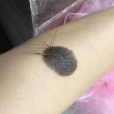 黑毛痣胎记对身体有影响吗？